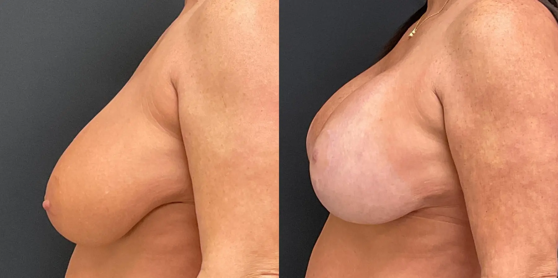 Breast Augmentation: Patient 6 - Before and After 4