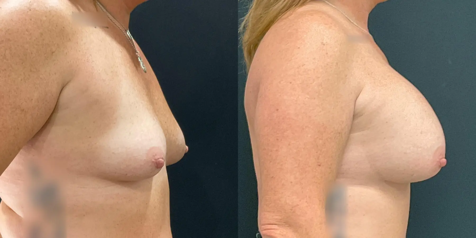 Breast Augmentation: Patient 4 - Before and After 5