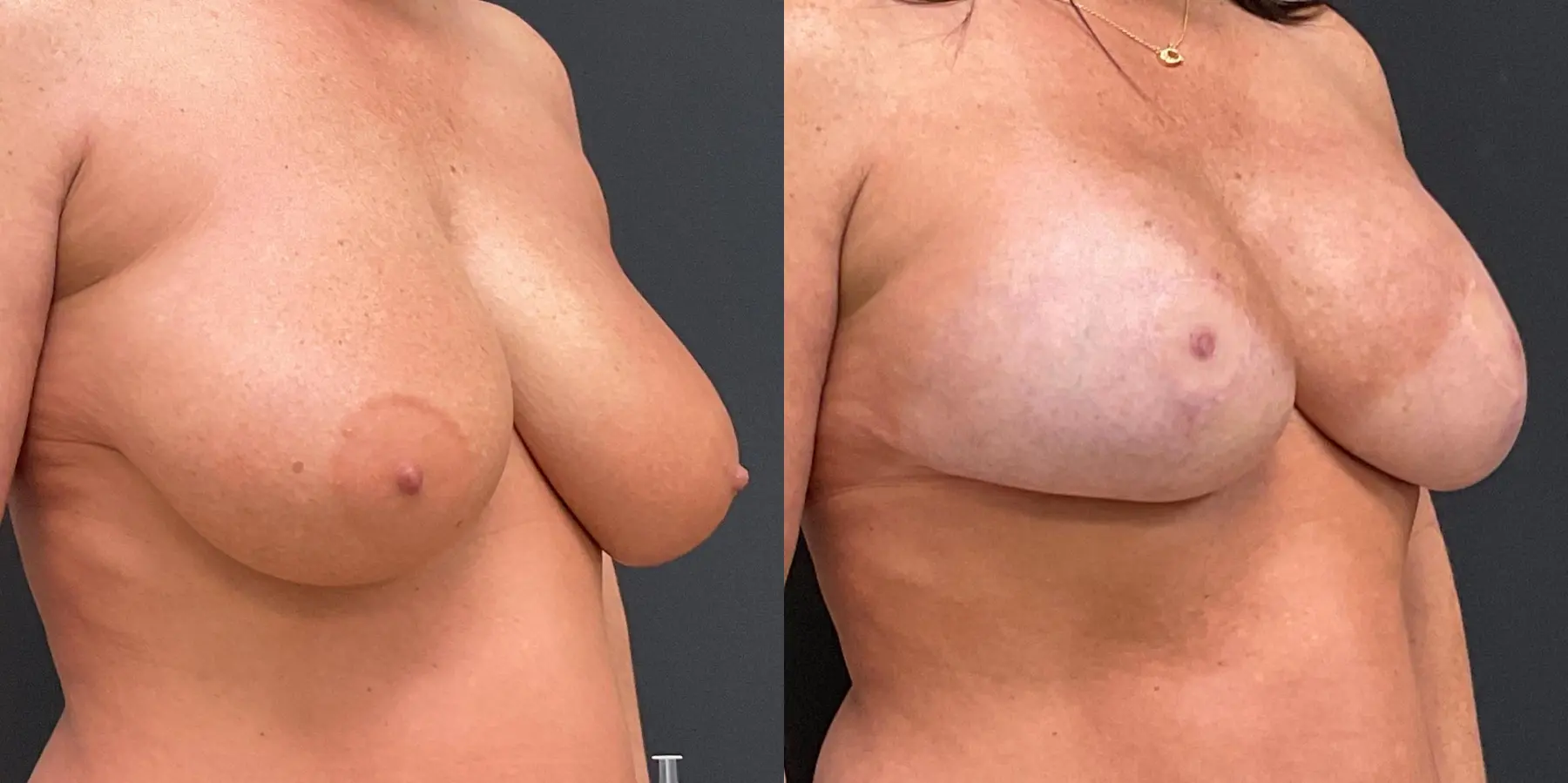 Breast Augmentation: Patient 6 - Before and After 3