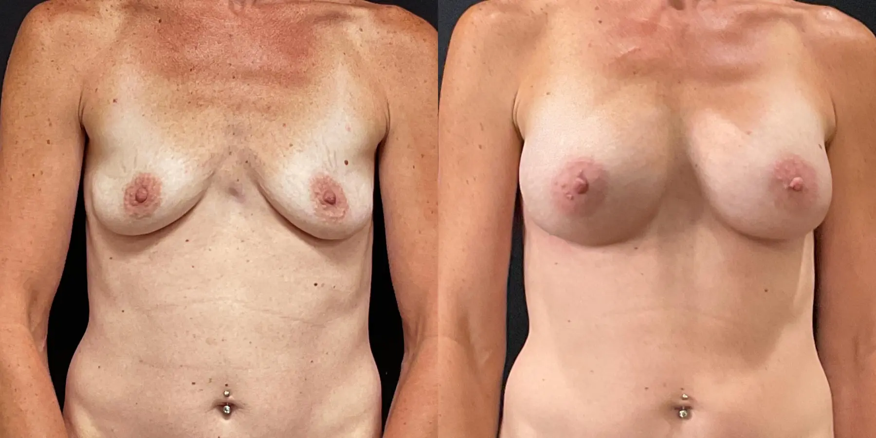 Breast Augmentation: Patient 7 - Before and After  