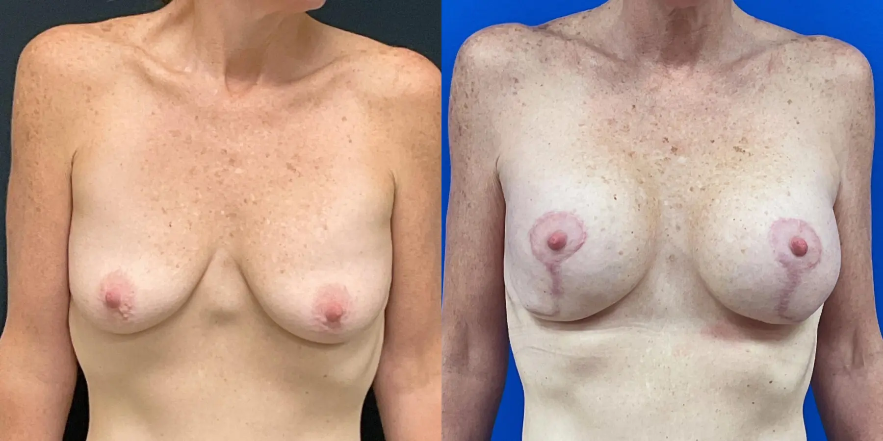 Breast Augmentation: Patient 9 - Before and After  