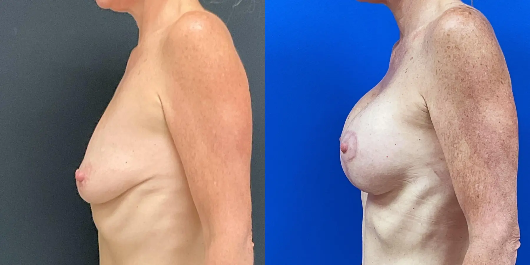 Breast Augmentation: Patient 7 - Before and After 4