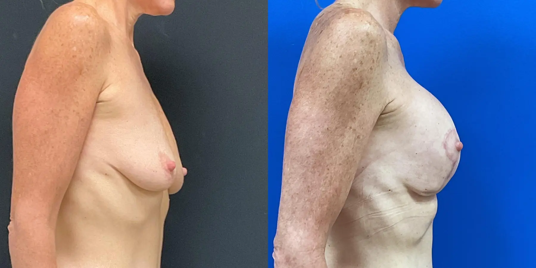 Breast Augmentation: Patient 9 - Before and After 5