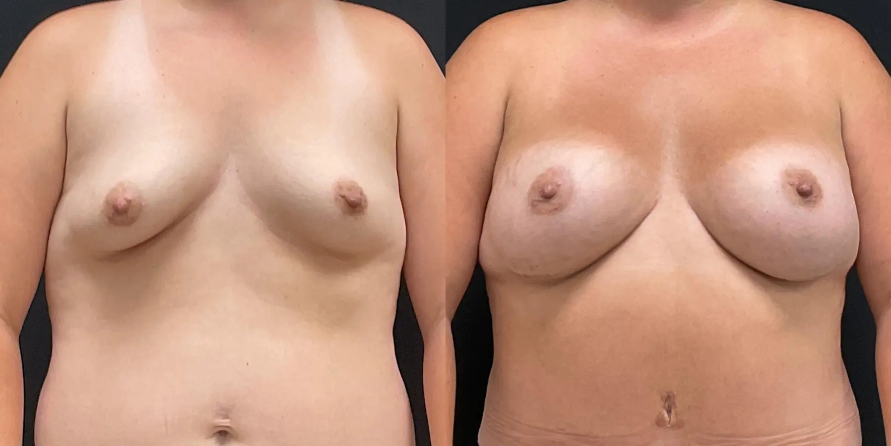 Breast Augmentation: Patient 2 - Before and After 1