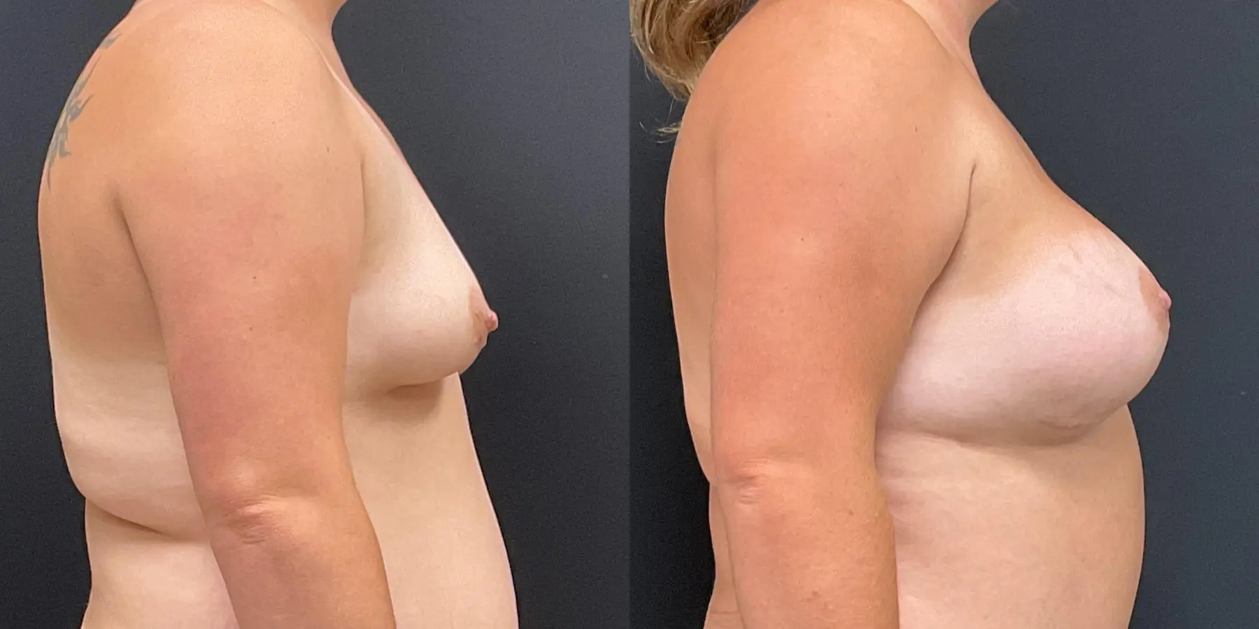 Breast Augmentation: Patient 4 - Before and After 5