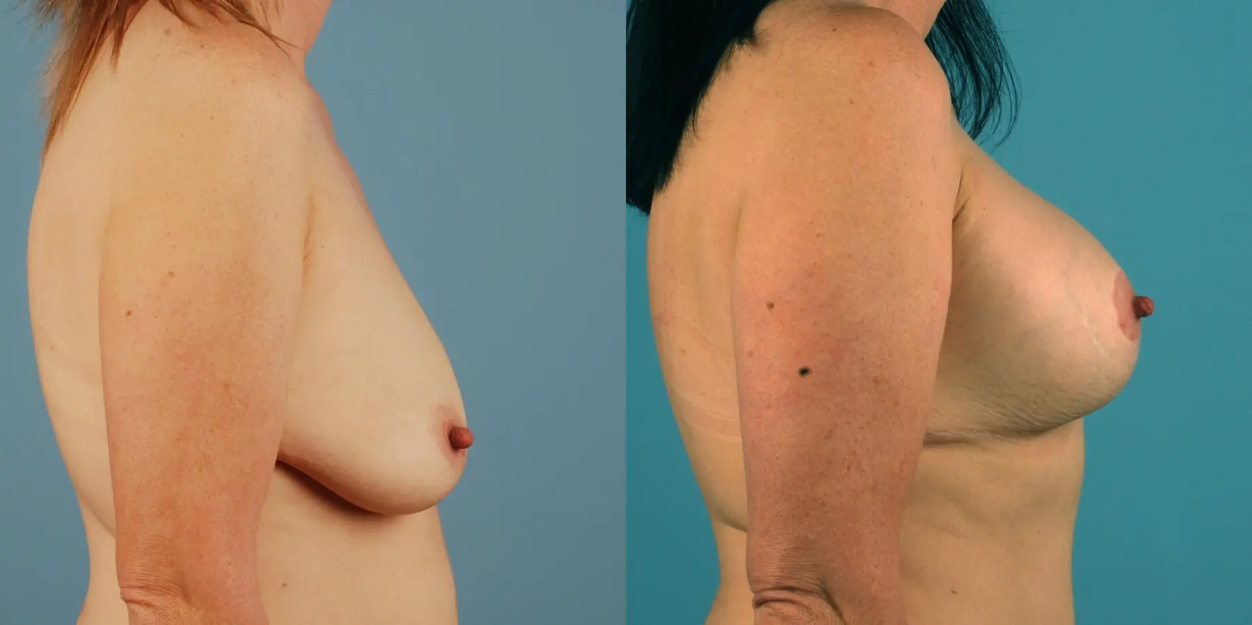 Breast Augmentation: Patient 8 - Before and After 2