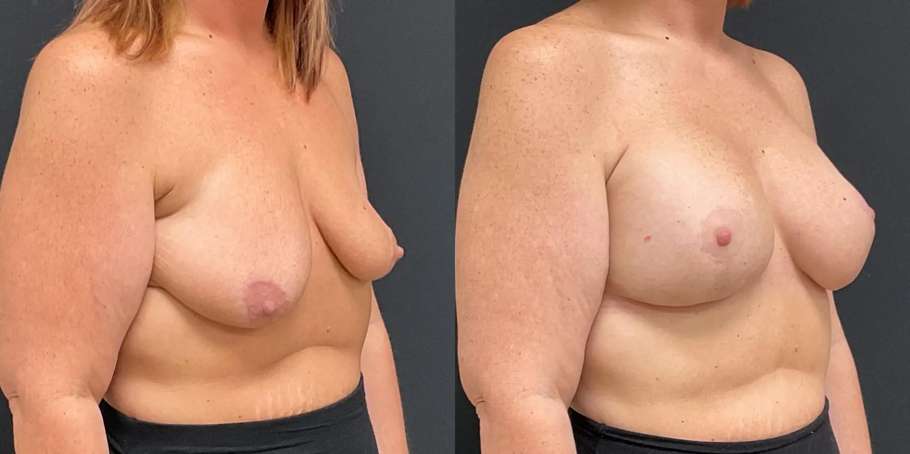 Breast Augmentation: Patient 11 - Before and After 3