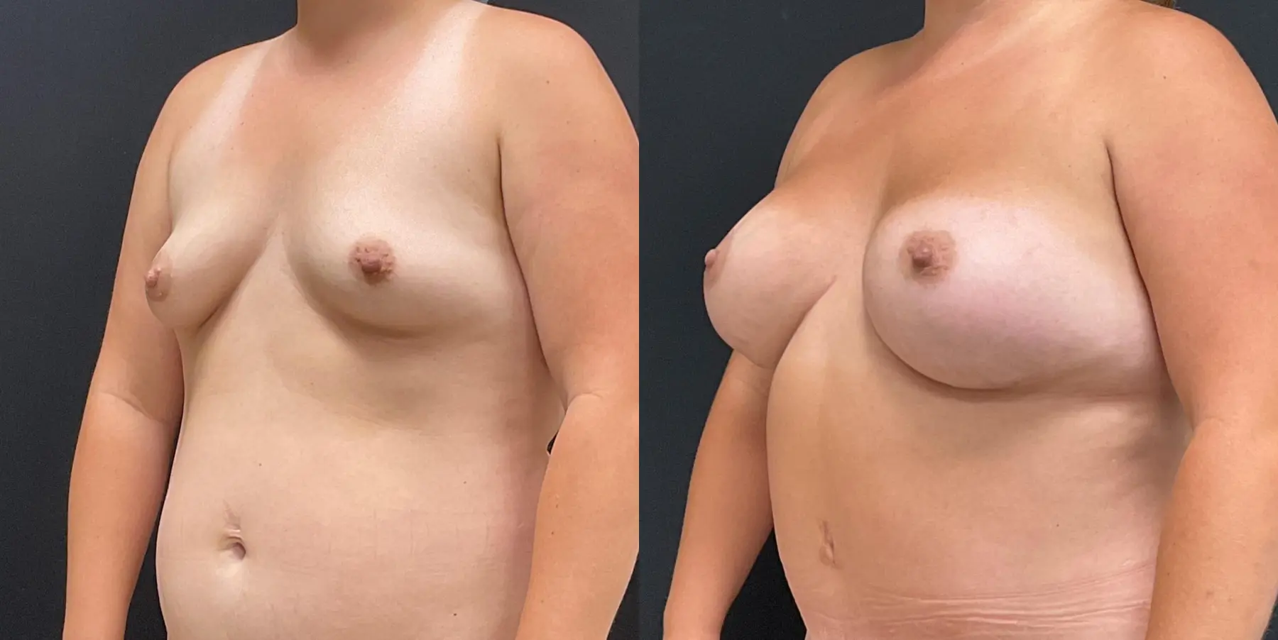 Breast Augmentation: Patient 2 - Before and After 2