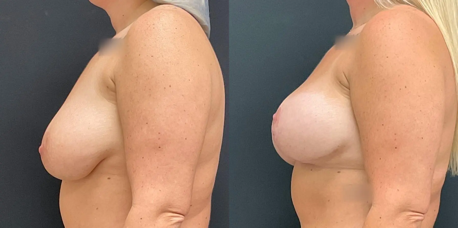 Breast Augmentation: Patient 11 - Before and After 4