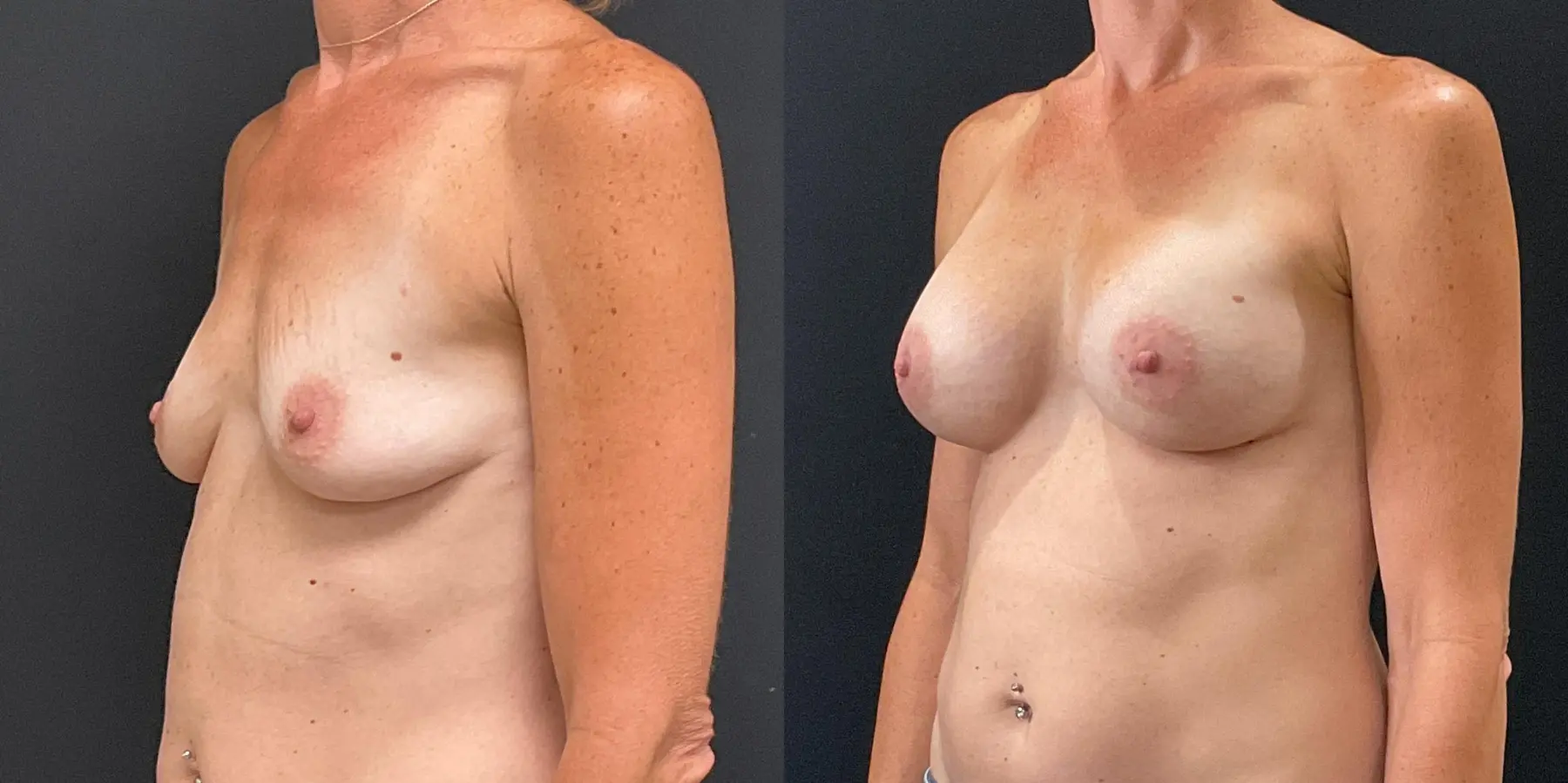 Breast Augmentation: Patient 7 - Before and After 2