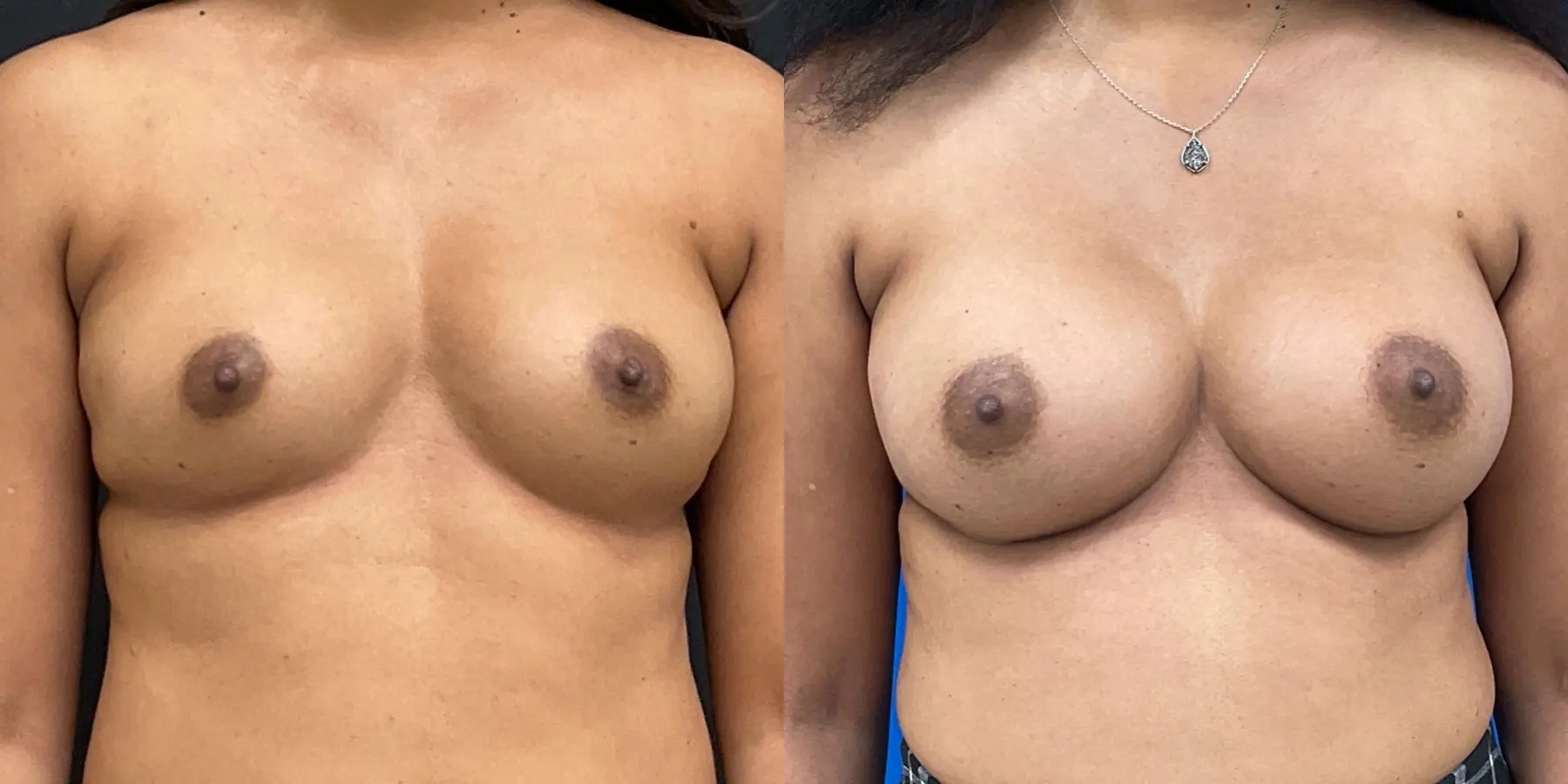 Breast Augmentation: Patient 2 - Before and After 1