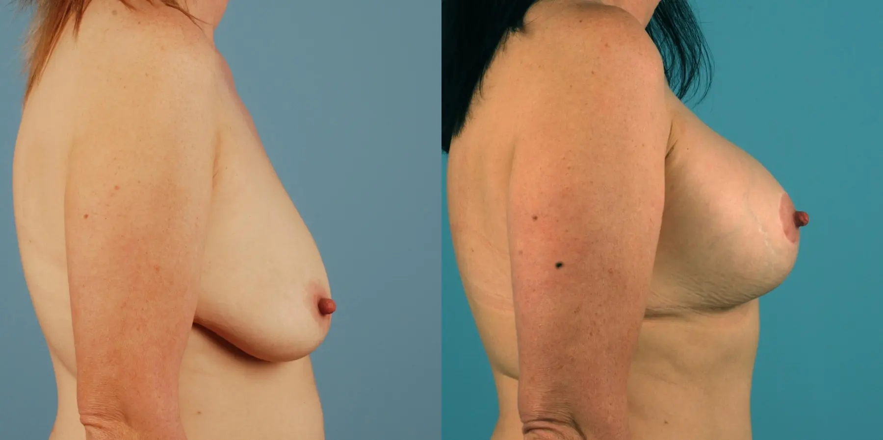 Breast Lift: Patient 10 - Before and After 2