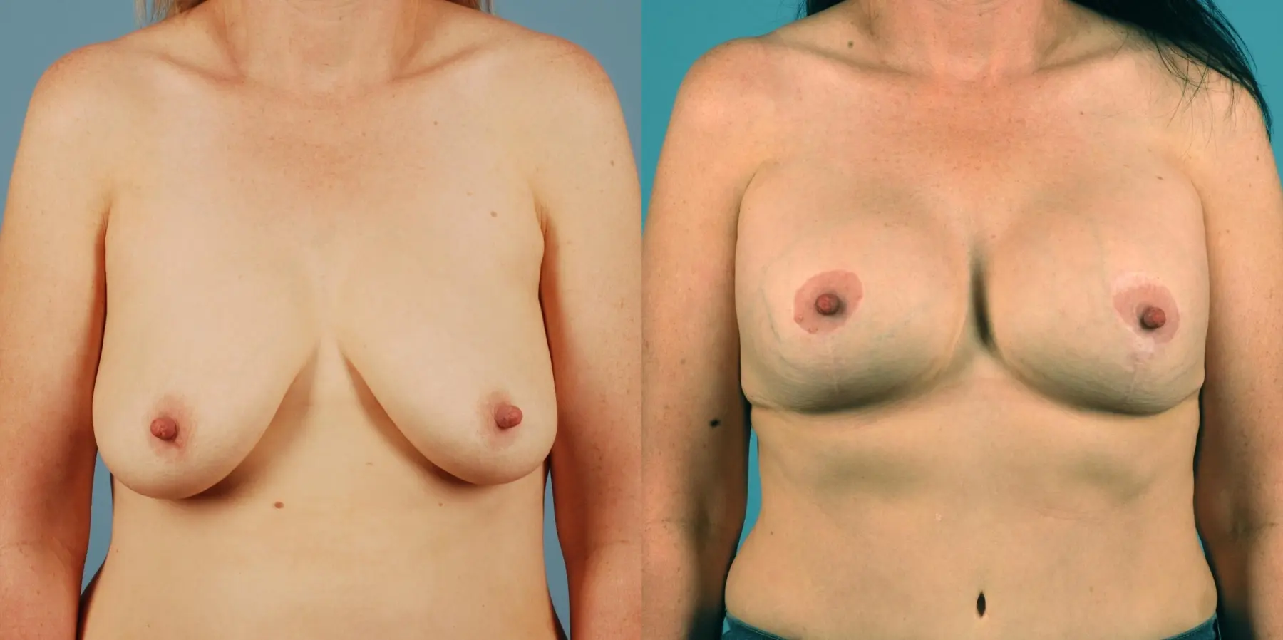 Breast Lift: Patient 4 - Before and After  