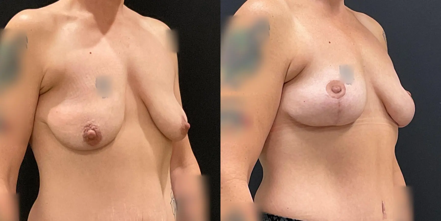 Breast Lift: Patient 7 - Before and After 3