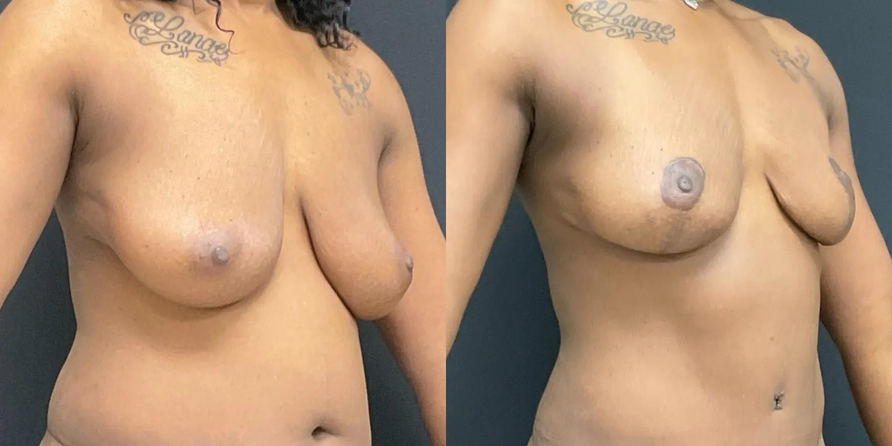 Breast Lift: Patient 9 - Before and After 3