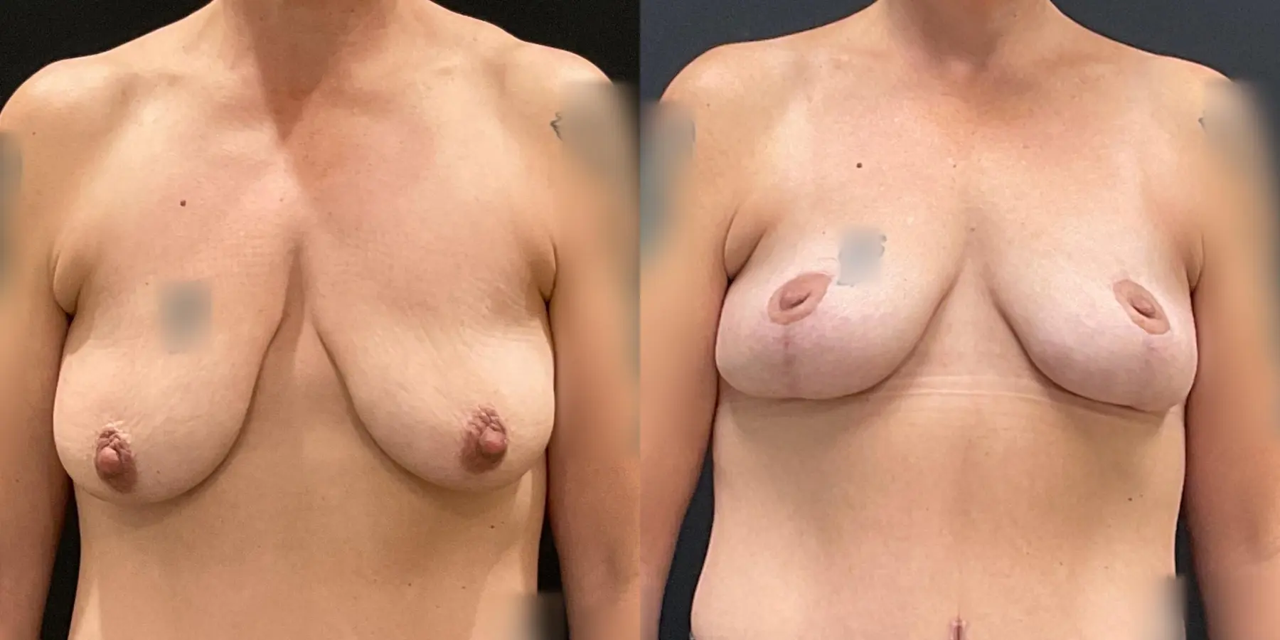 Breast Lift: Patient 7 - Before and After  