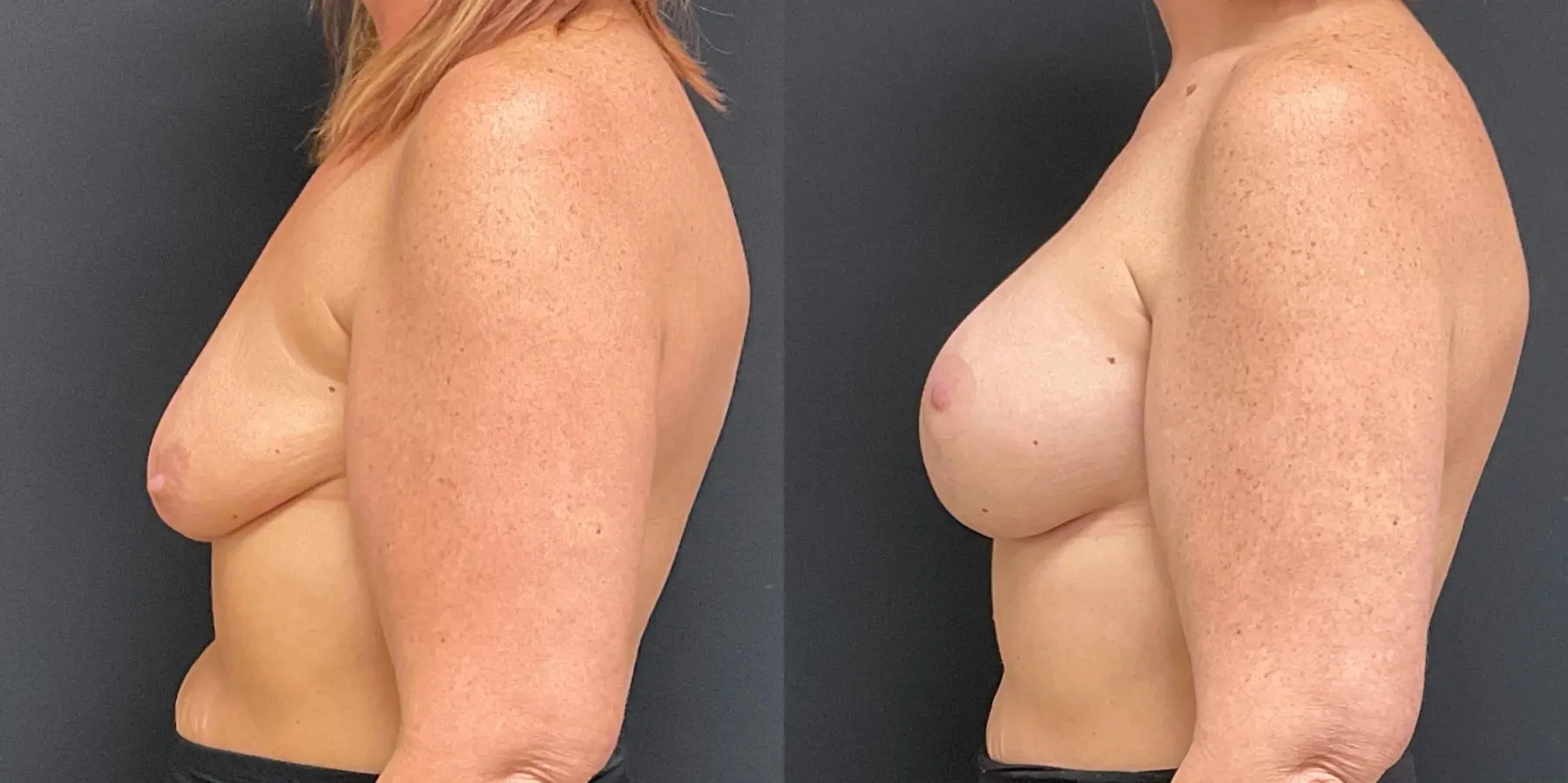 Breast Lift: Patient 6 - Before and After 4