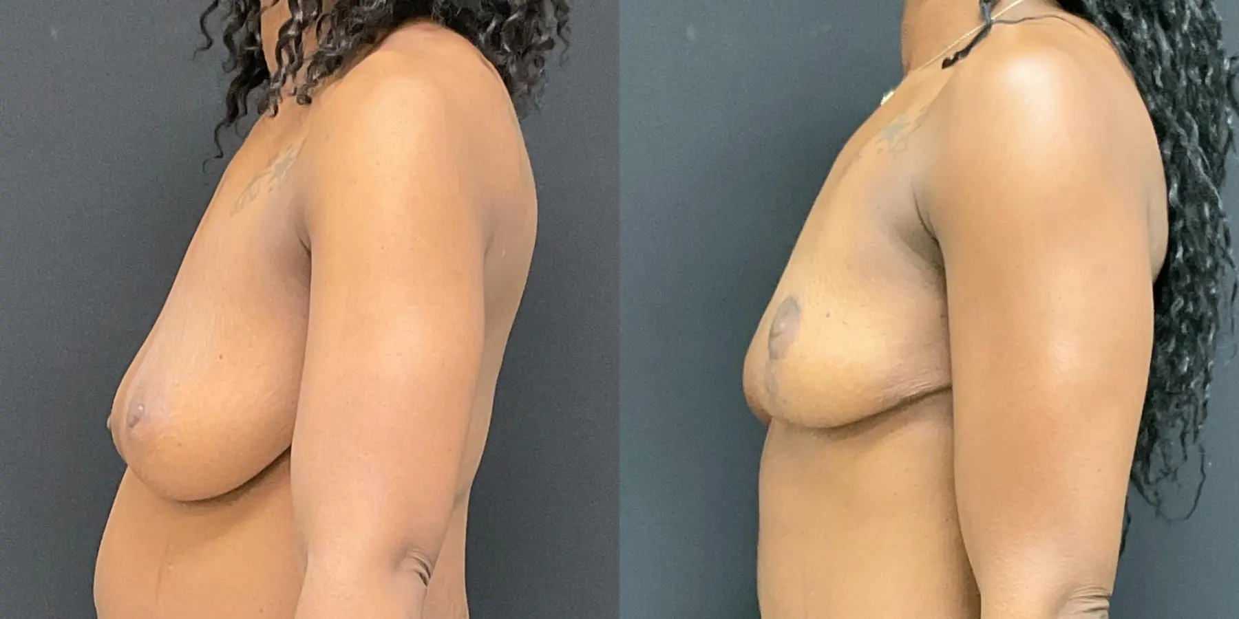 Breast Lift: Patient 9 - Before and After 4