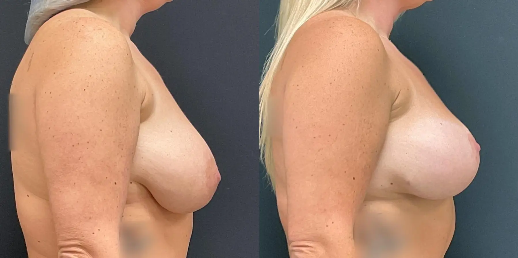 Breast Lift: Patient 8 - Before and After 5