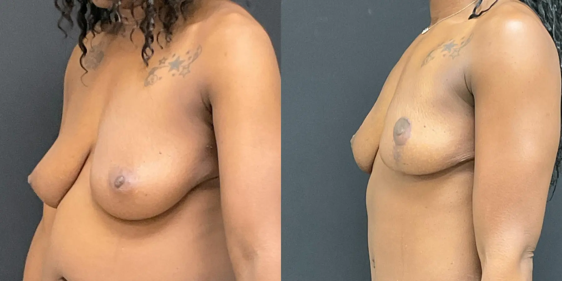 Breast Lift: Patient 9 - Before and After 2