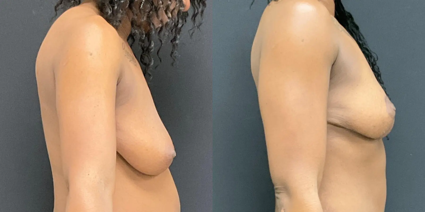 Breast Lift: Patient 9 - Before and After 5