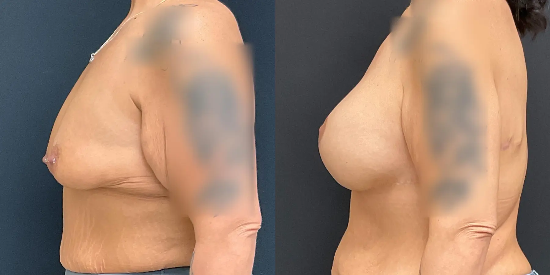 Breast Lift: Patient 7 - Before and After 4