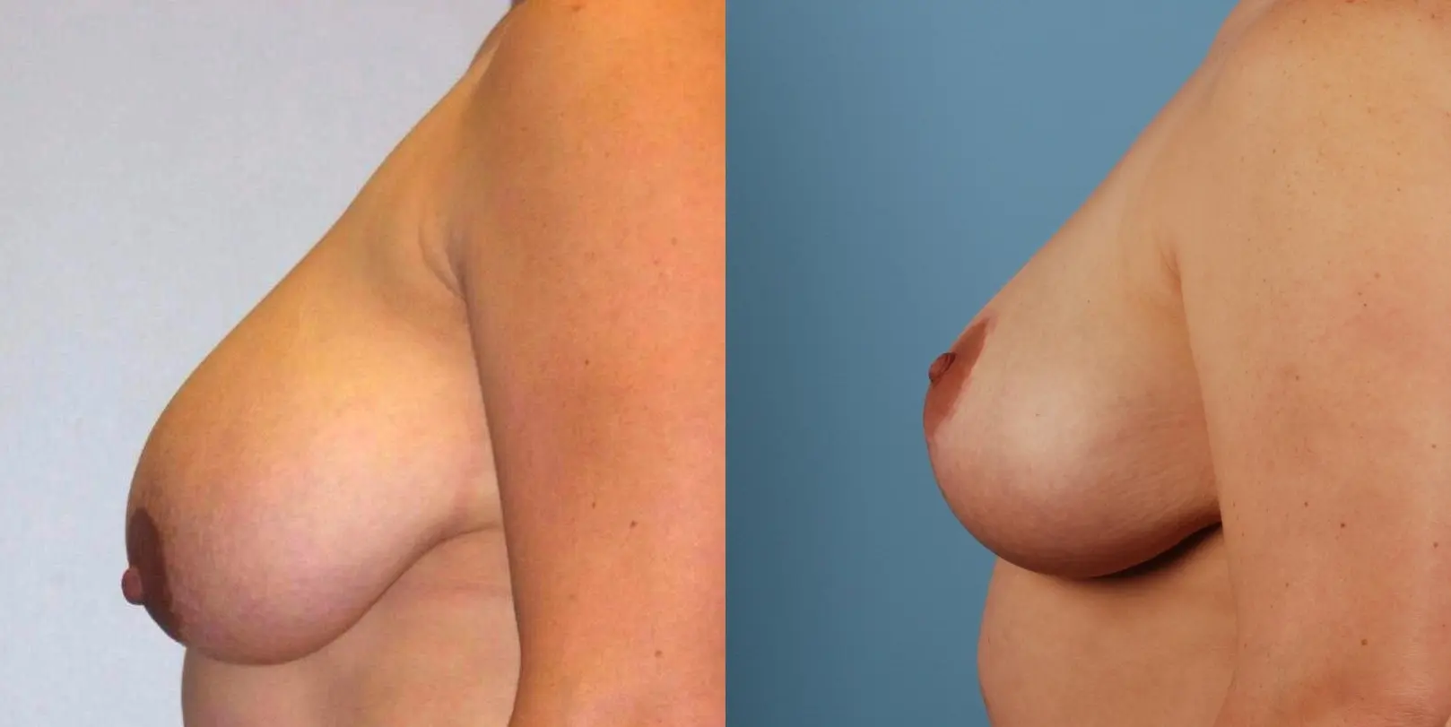 Breast Reduction: Patient 3 - Before and After 3