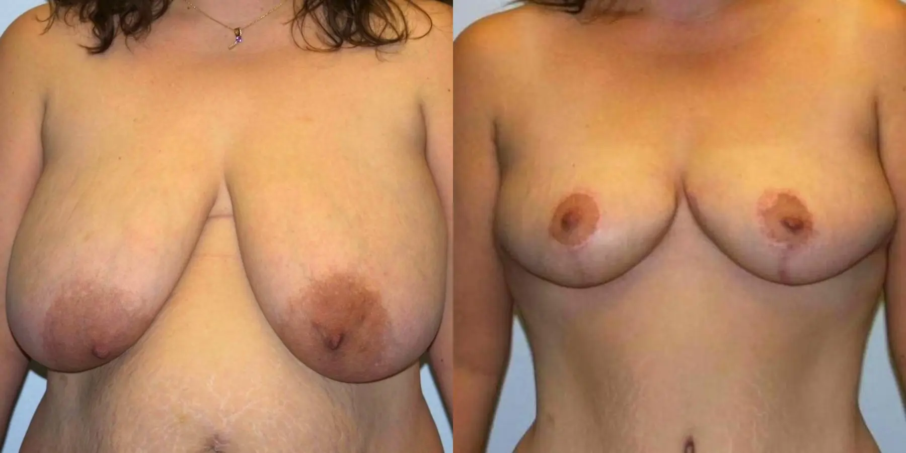 Breast Reduction: Patient 5 - Before and After 1