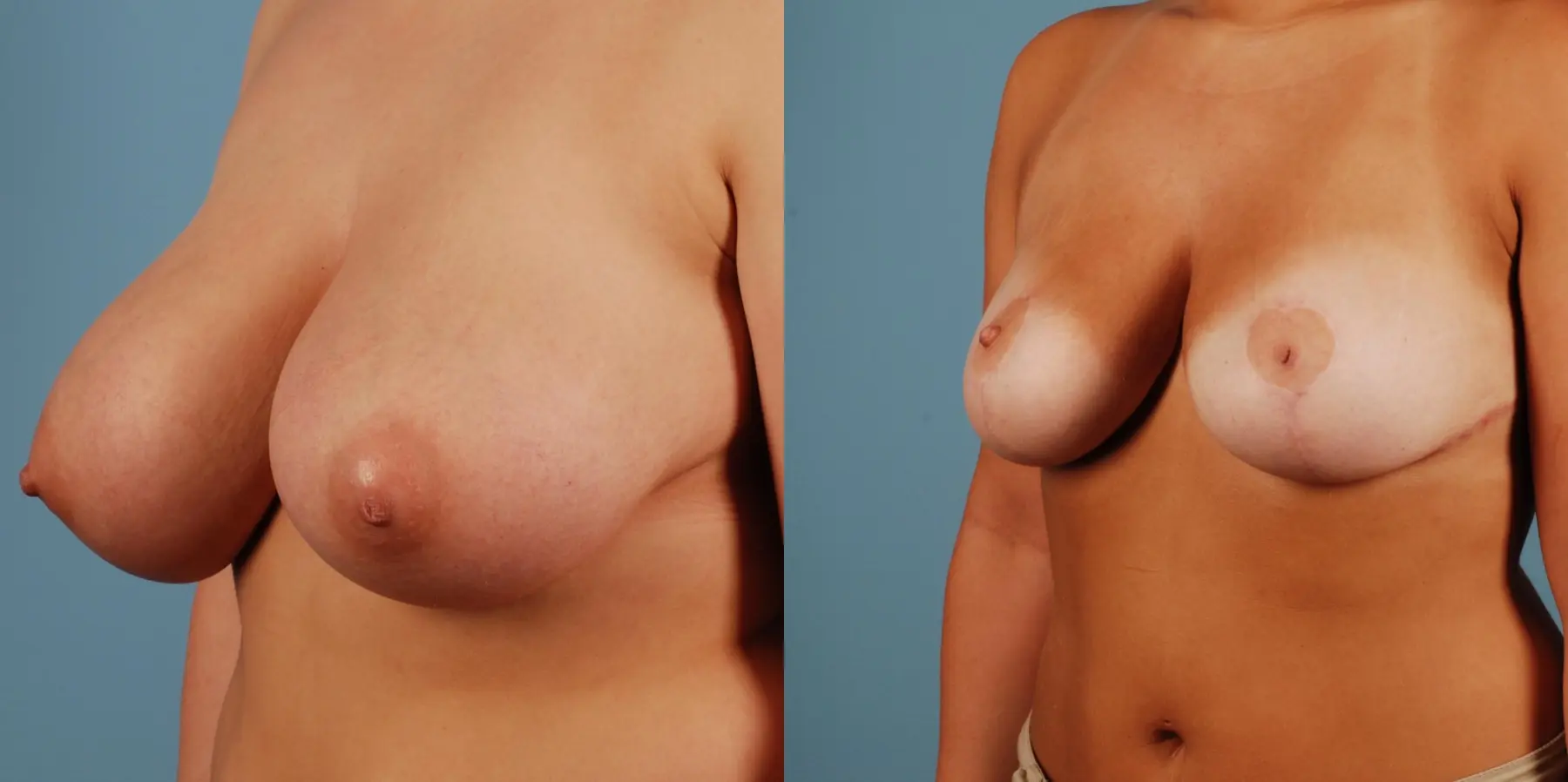 Breast Reduction: Patient 4 - Before and After 2