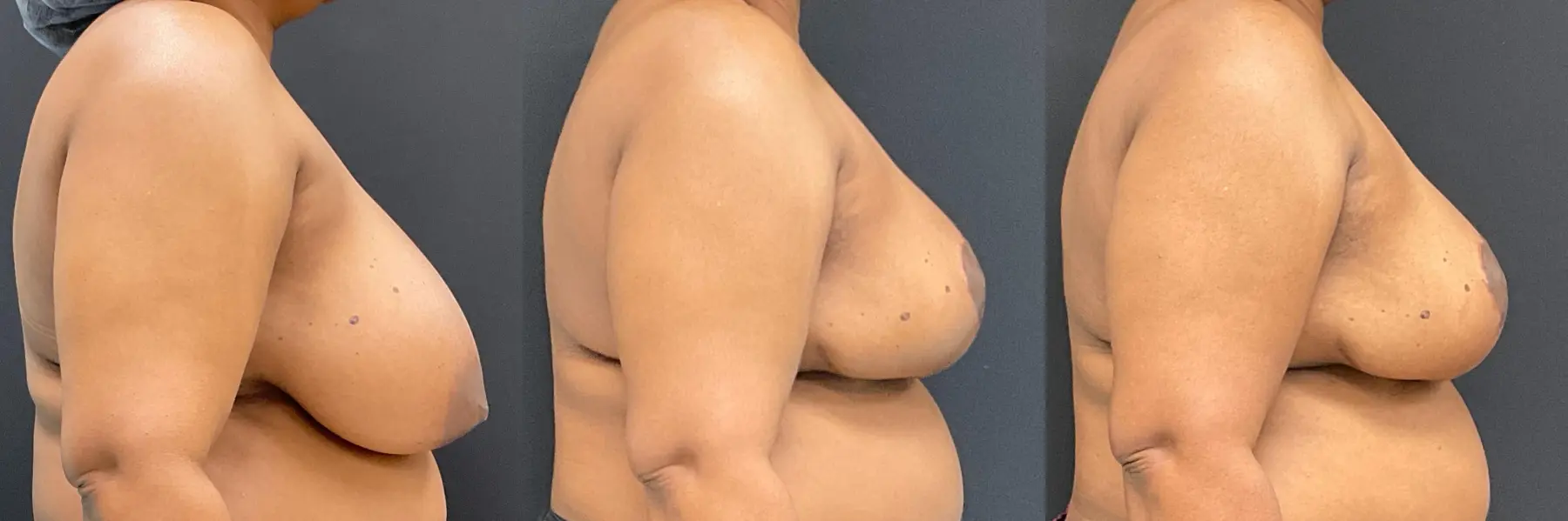 Breast Reduction: Patient 6 - Before and After 5