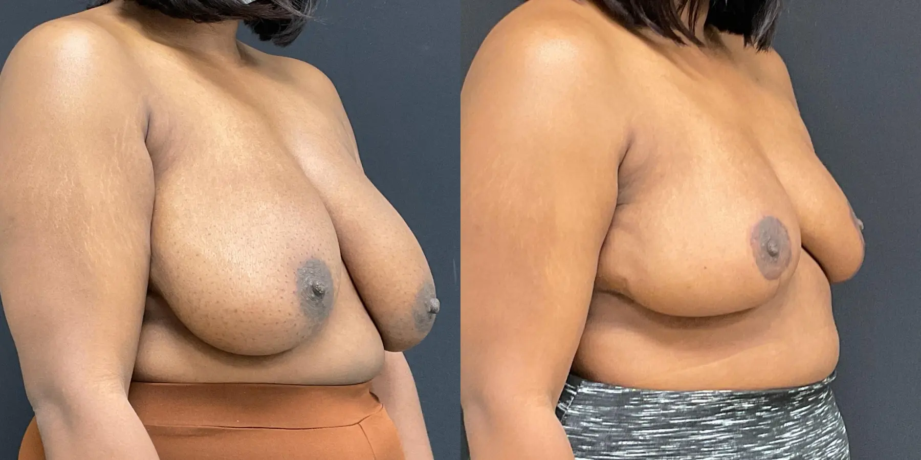 Breast Reduction: Patient 1 - Before and After 3