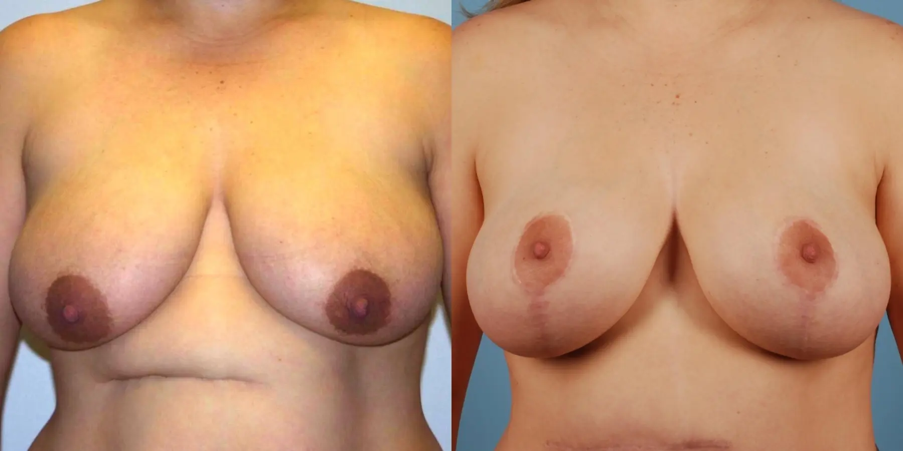 Breast Reduction: Patient 3 - Before and After 1