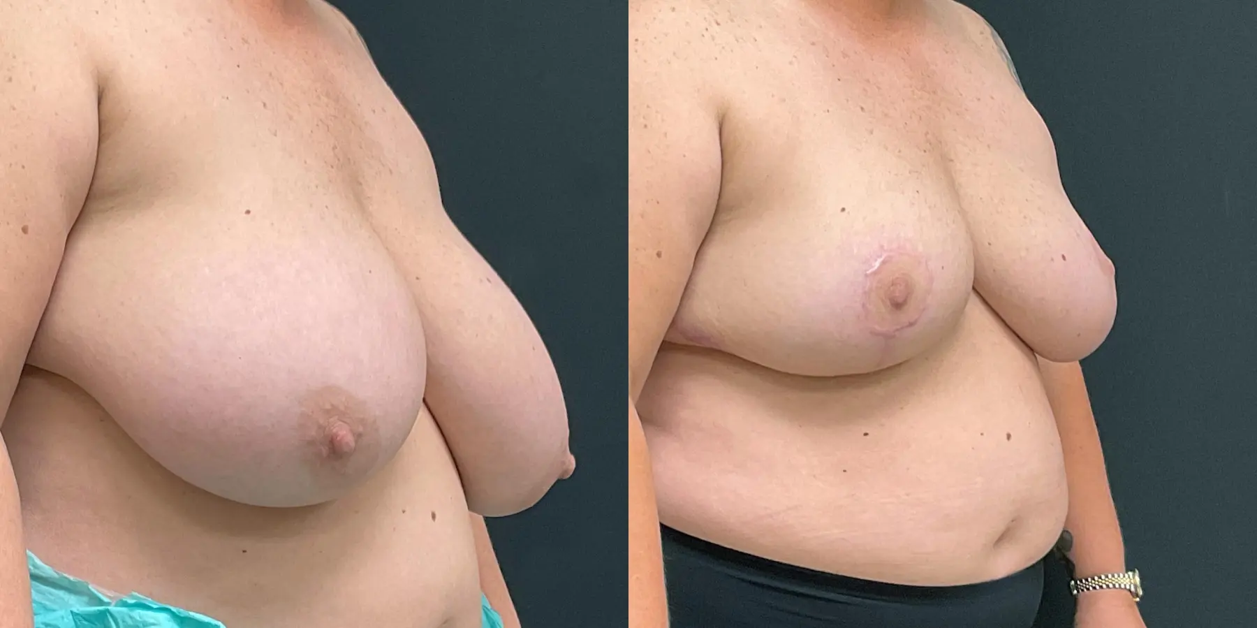 Breast Reduction: Patient 2 - Before and After 3