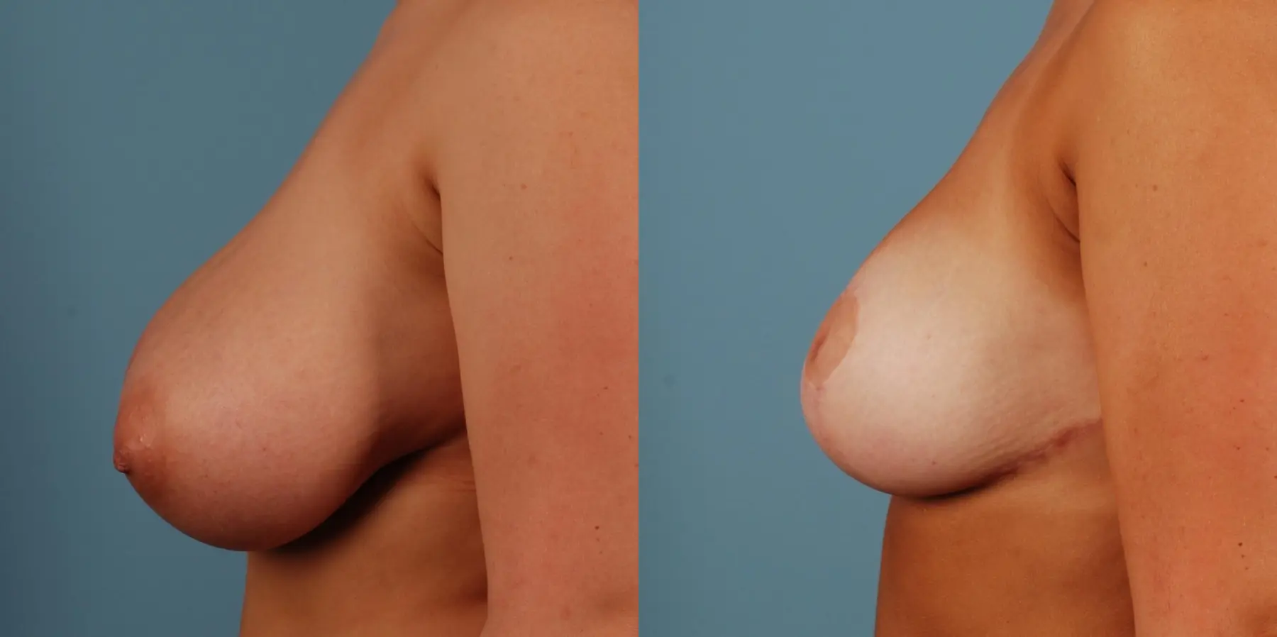 Breast Reduction: Patient 4 - Before and After 3