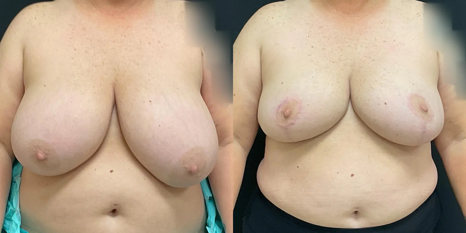 Breast Reduction: Patient 2 - Before and After  