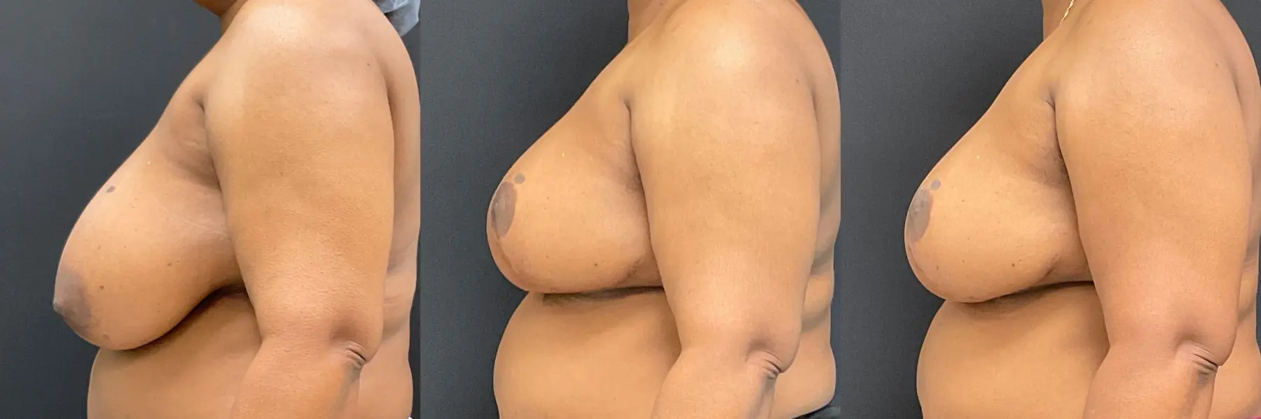 Breast Reduction: Patient 6 - Before and After 4