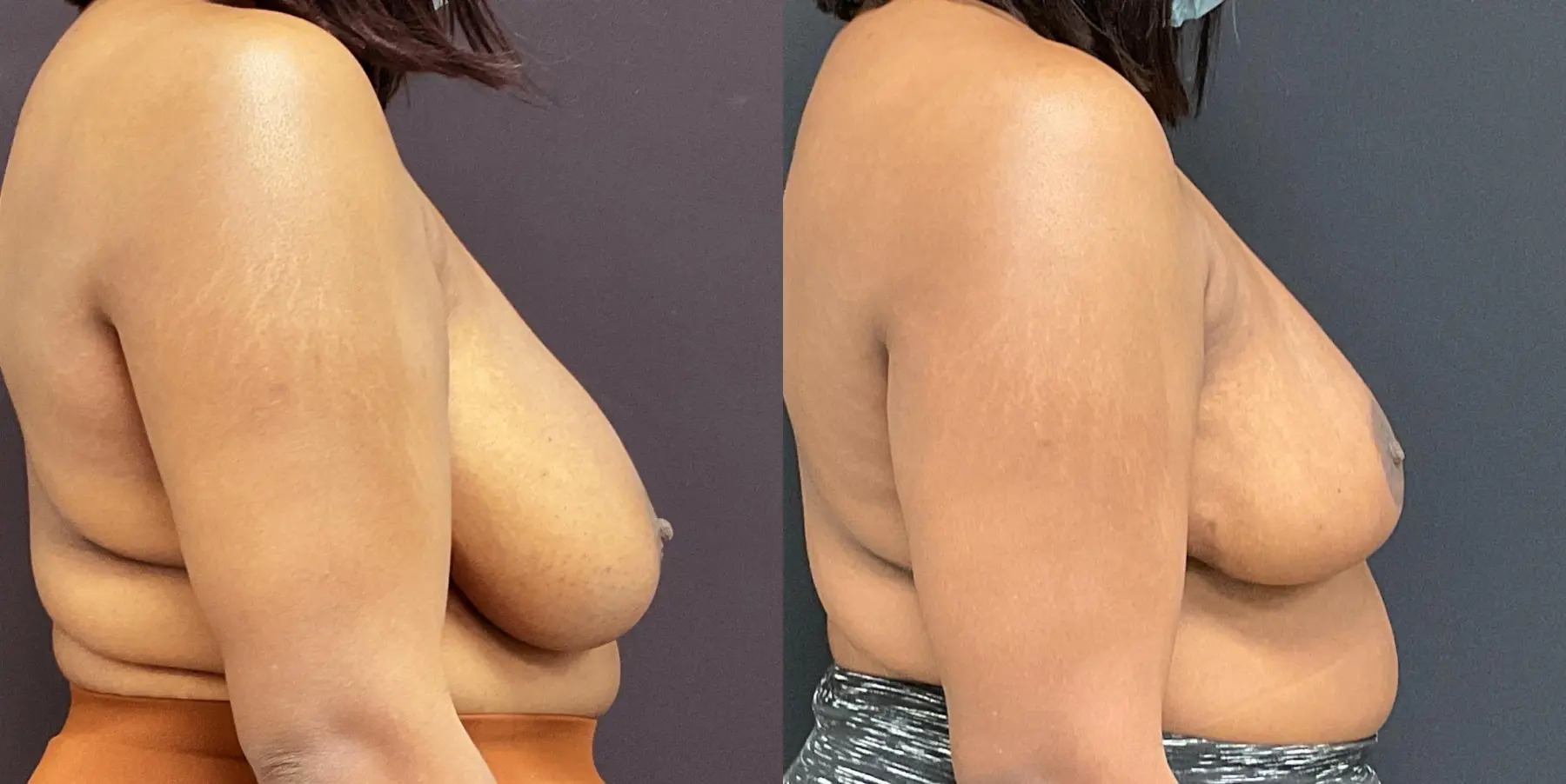 Breast Reduction: Patient 1 - Before and After 5