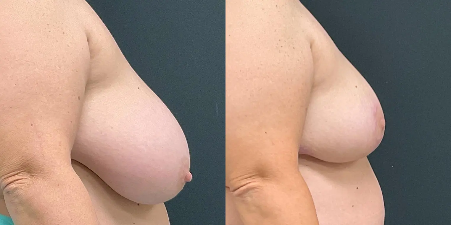 Breast Reduction: Patient 2 - Before and After 5