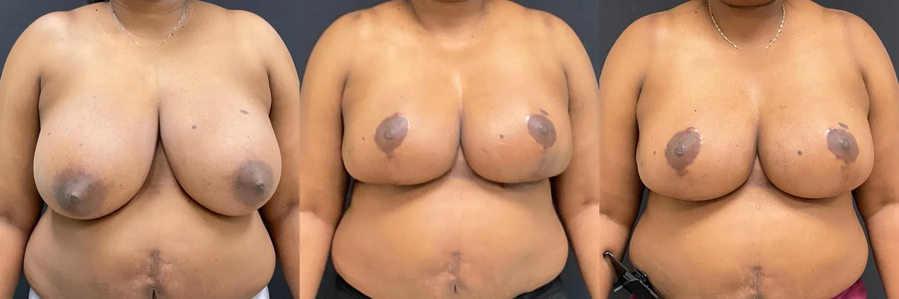 Breast Reduction: Patient 6 - Before and After  