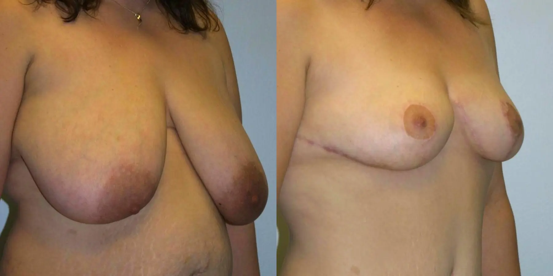 Breast Reduction: Patient 5 - Before and After 2