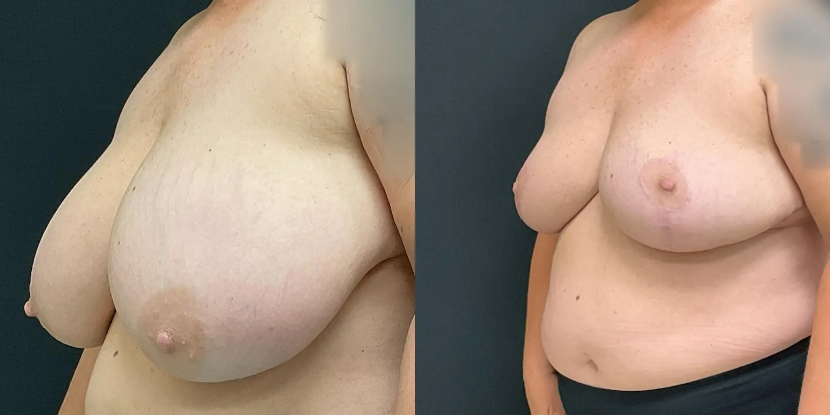 Breast Reduction: Patient 2 - Before and After 2