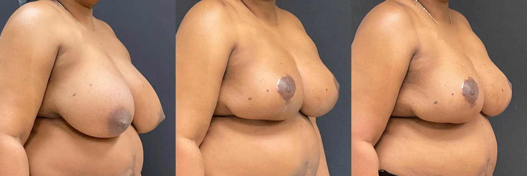 Breast Reduction: Patient 6 - Before and After 3