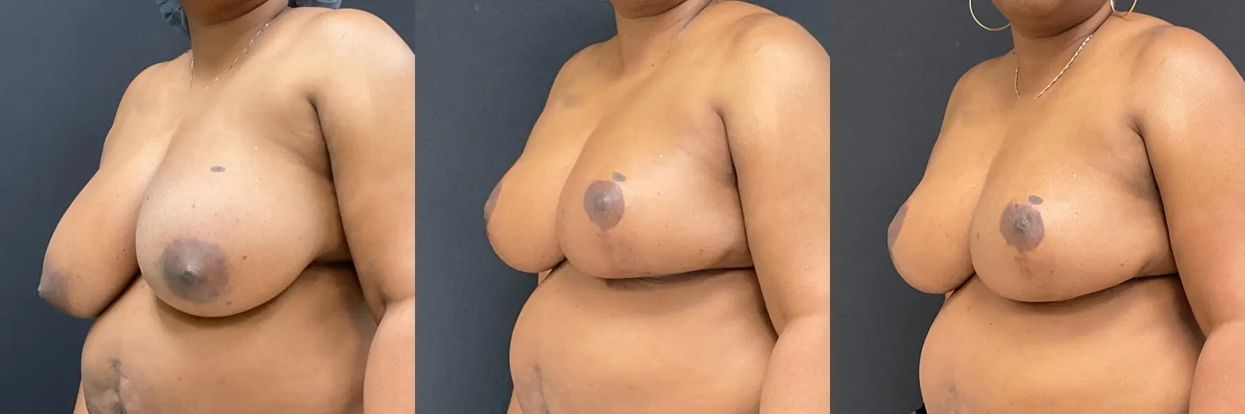 Breast Reduction: Patient 6 - Before and After 2