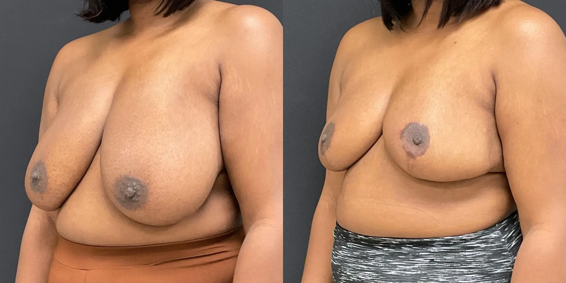 Breast Reduction: Patient 1 - Before and After 2