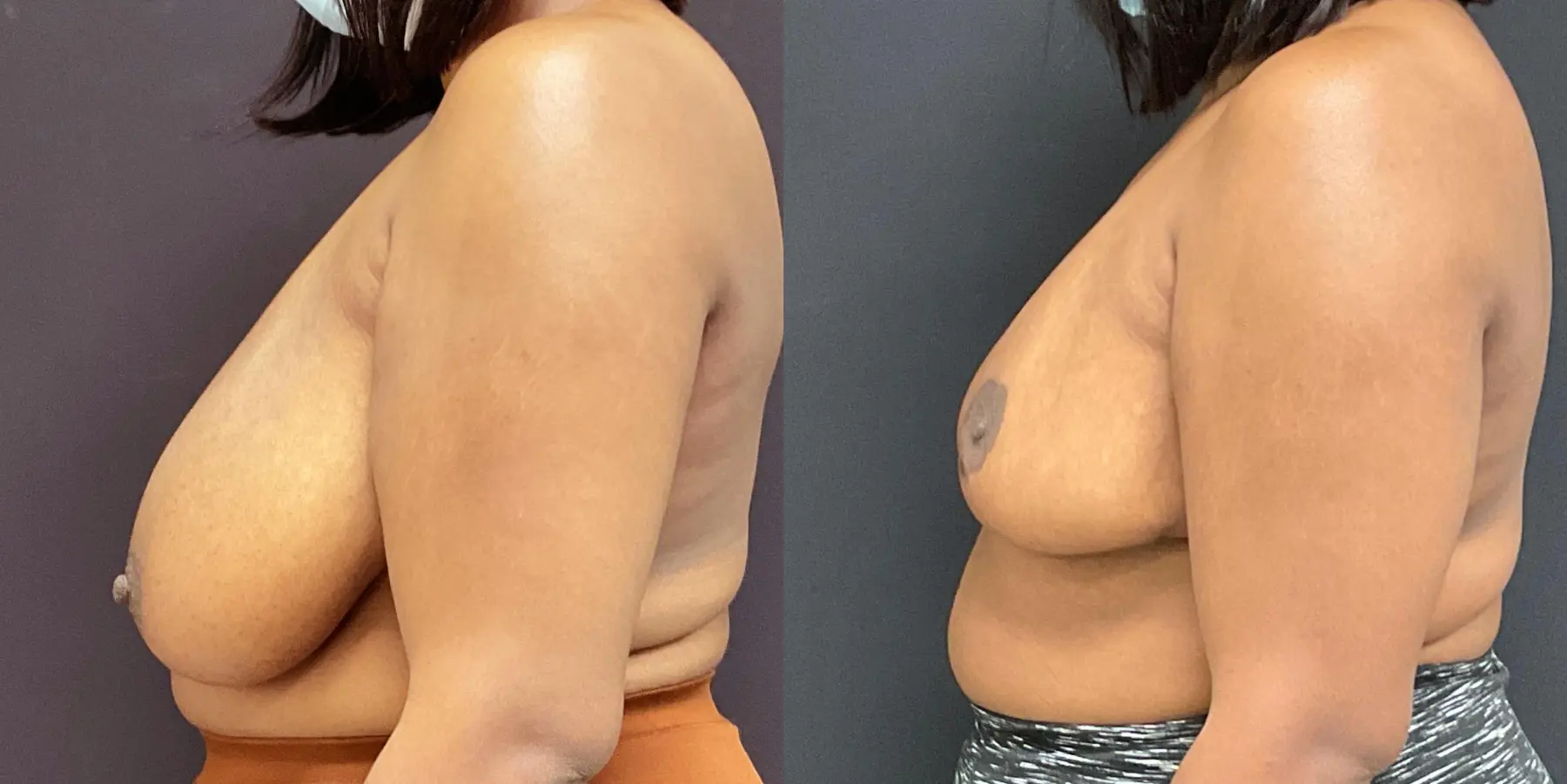 Breast Reduction: Patient 1 - Before and After 4