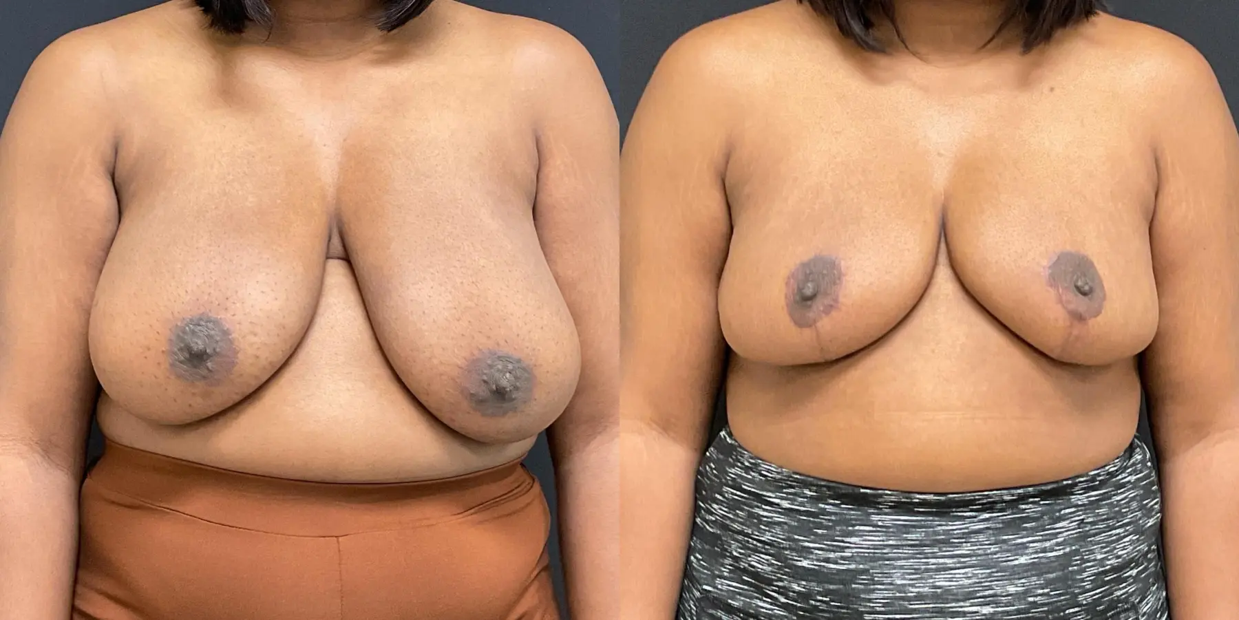 Breast Reduction: Patient 1 - Before and After 1