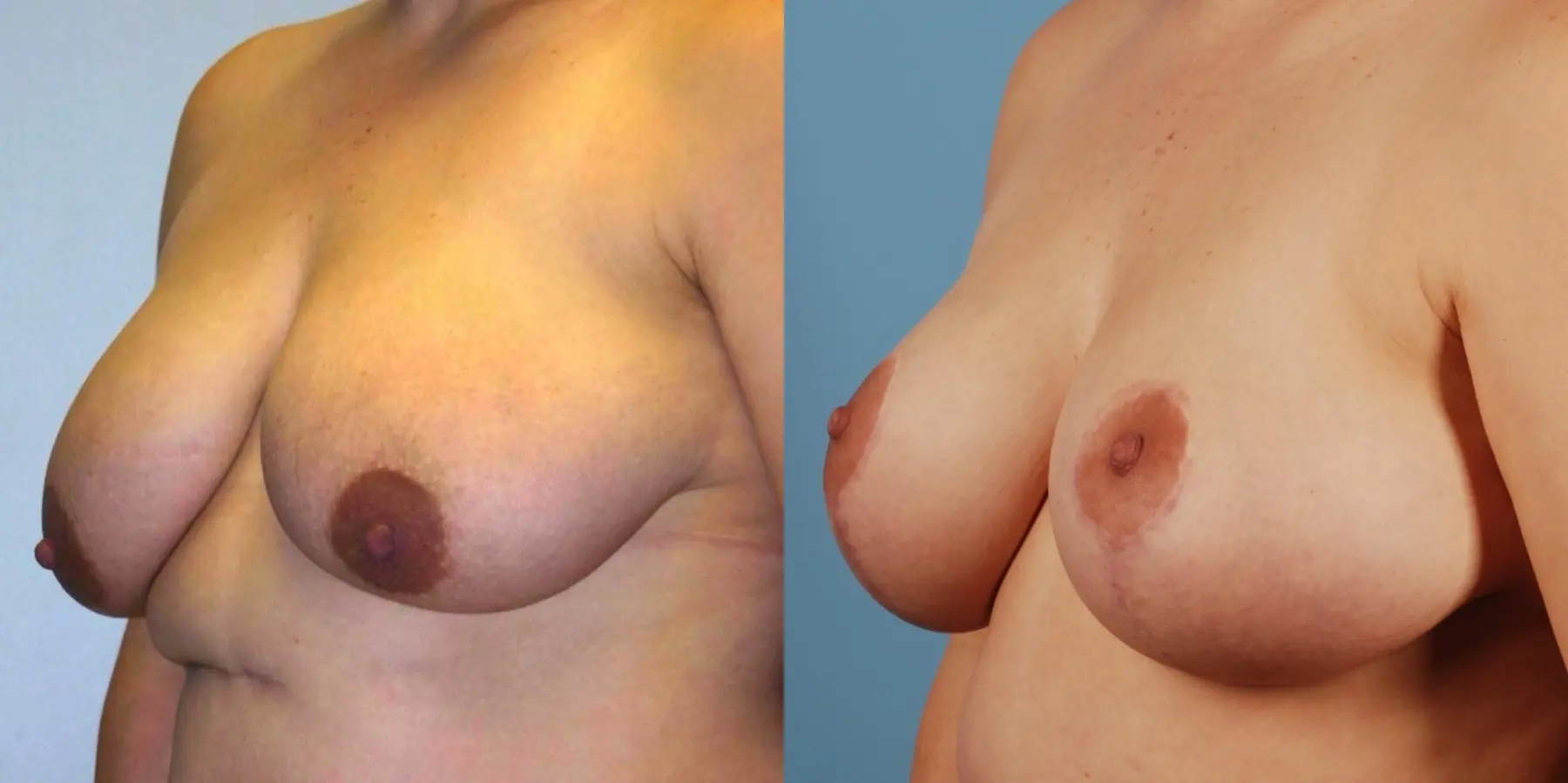 Breast Reduction: Patient 3 - Before and After 2