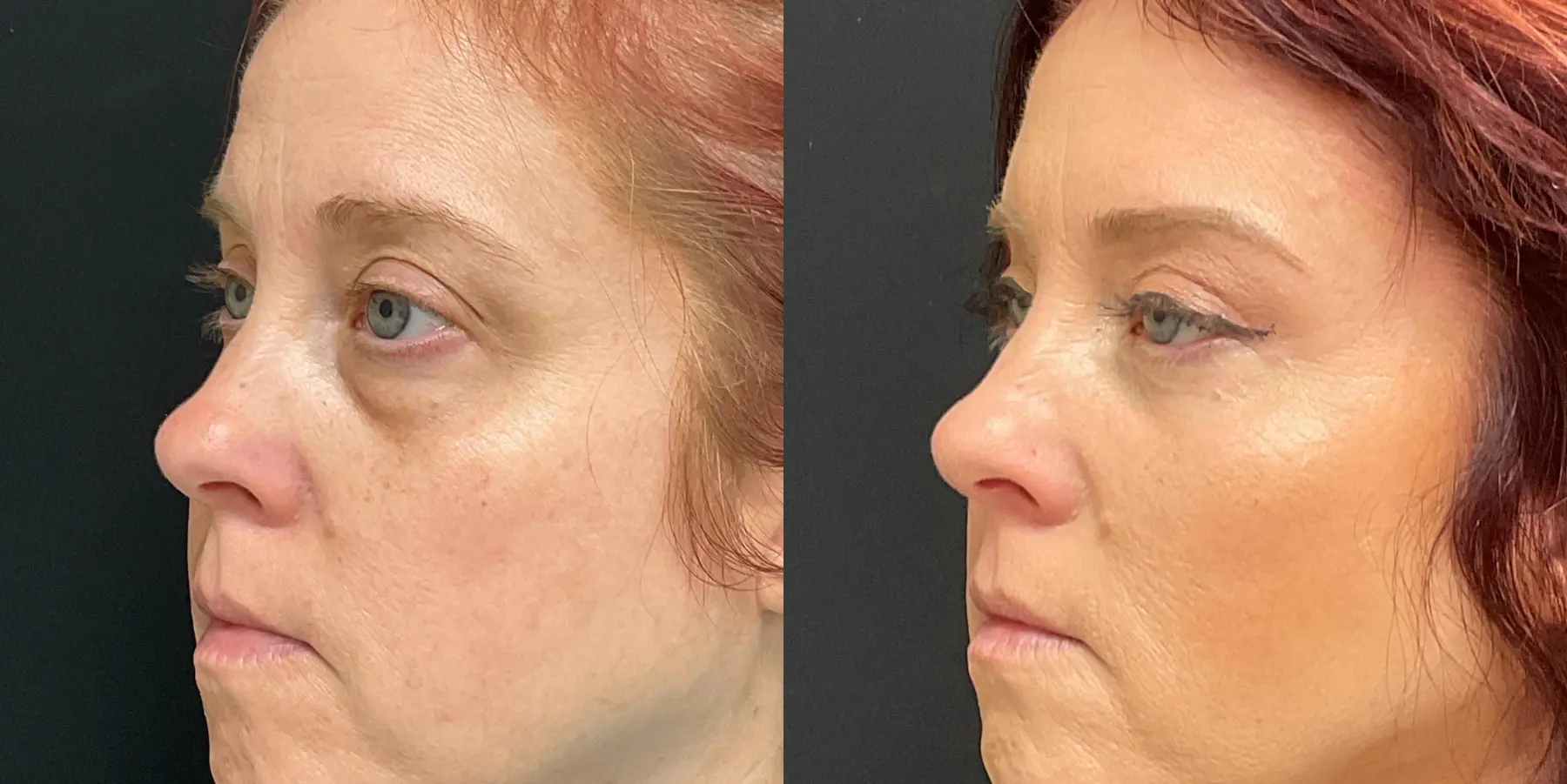 Brow Lift: Patient 1 - Before and After 2