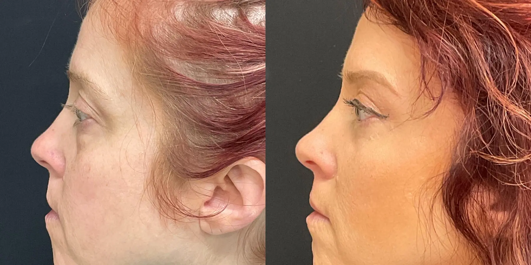 Brow Lift: Patient 1 - Before and After 4