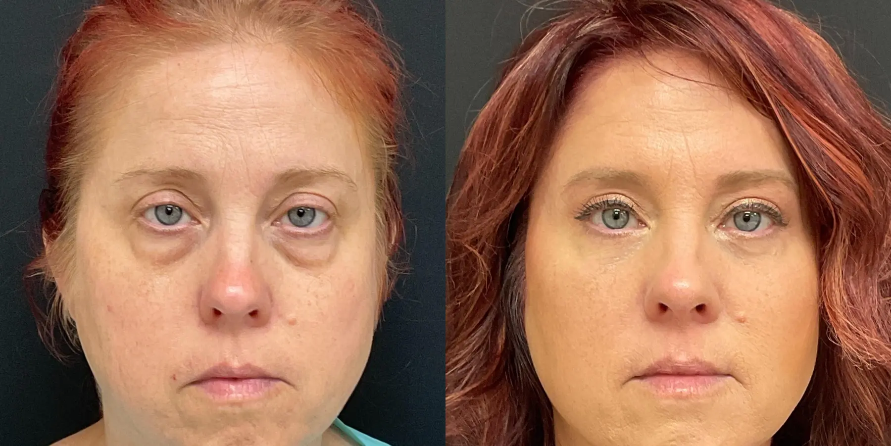 Brow Lift: Patient 1 - Before and After 1